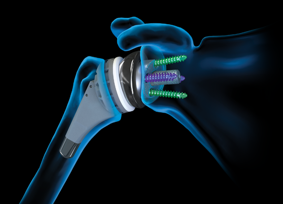 Arthrex - Rotation Lasso, 90° - AR-6065-90